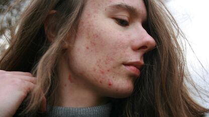 Wat is acne?